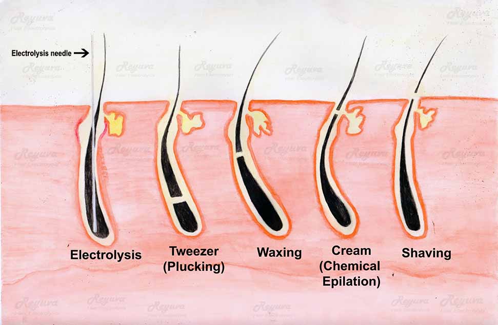 Electrolysis for permanent hair removal