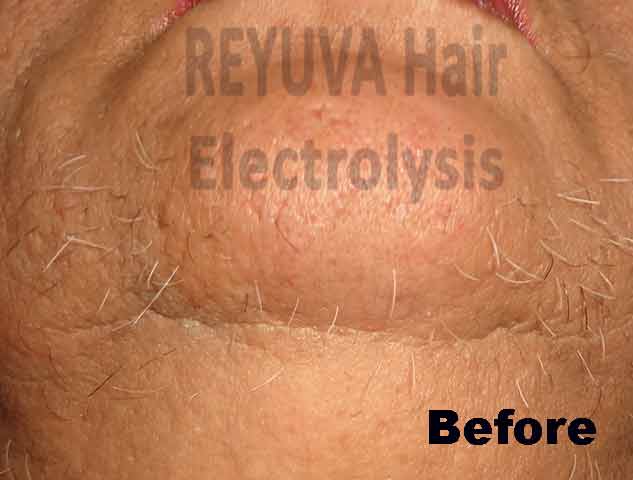 White Hair Removal